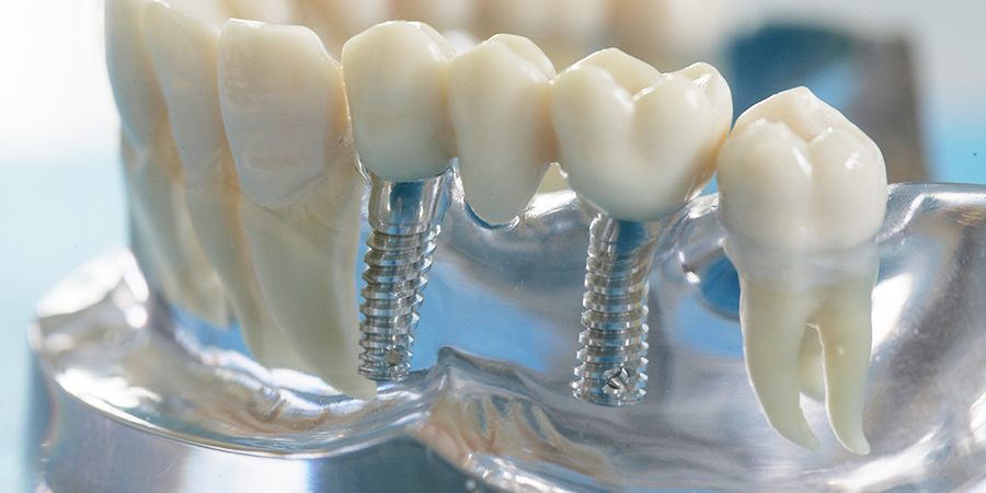 Zahnimplantate